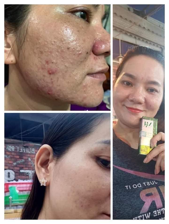 Đặc tính của DR.MAI là gom cồi, khô cồi & đẩy nhân mụn lên trên bề mặt da