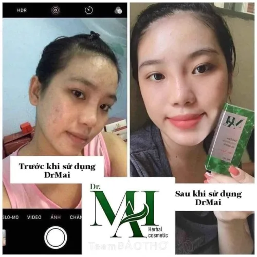 4 lý do – bất kỳ ai cũng cần 1 lọ Dr Mai trị mụn cho riêng mình
