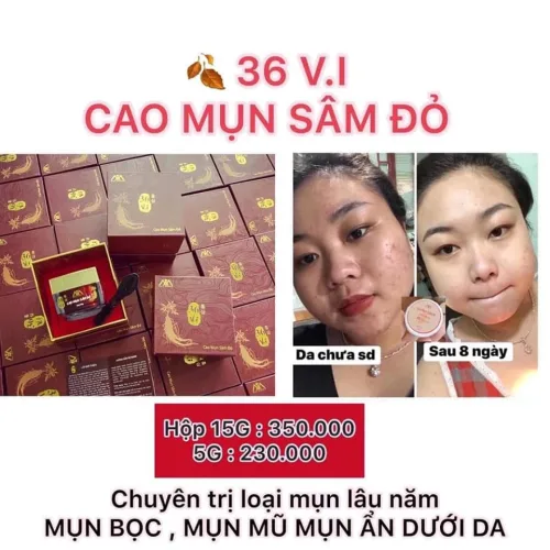 Cao Mụn Sâm Đỏ 36 Vị Thuốc Bắc – Vua Trị Mụn