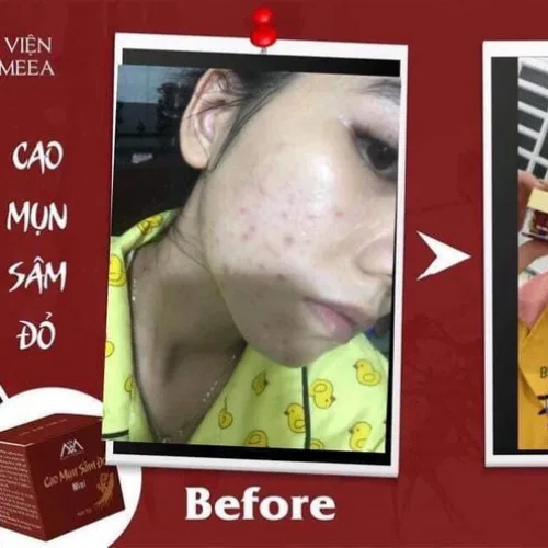 Cao Mụn Sâm Đỏ 36 Vị Thuốc Bắc – Vua Trị Mụn An Toàn