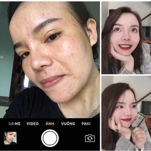 Có ai sau 25 tuổi vẫn còn bị mụn không?