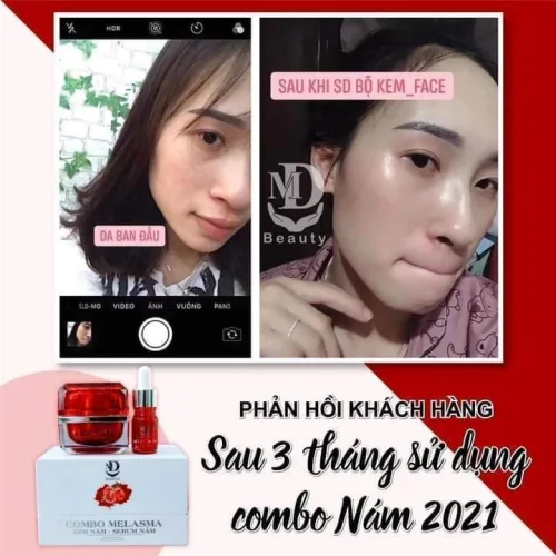Đánh bay gốc nám - tút da mịn màng với combo lựu đỏ MD BEAUTY