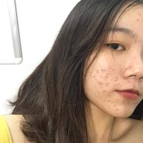 Điều trị mụn giờ đây trở nên đơn giản và tiết kiệm nhất chỉ với 230k