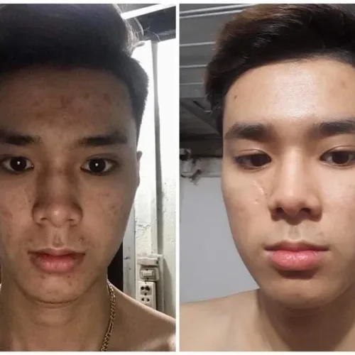 DR MAI trị mụn cho nam