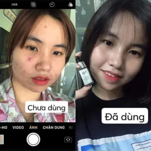 Đừng để mụn nặng rồi mới loay hoay tìm cách chữa trị nha mọi ngườiiiii