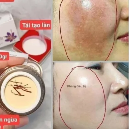 Feedback Kem Trị Nám Dưỡng Trắng Da Saffron Napoli Hải Âu Việt