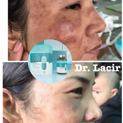 🌟 Giảm nám da với viên uống trắng da Dr Lacir không cần laser