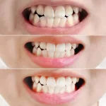 Kem Đánh Răng Median Màu Xanh Dương Dental IQ Tartar Toothpaste 93% Original 120g