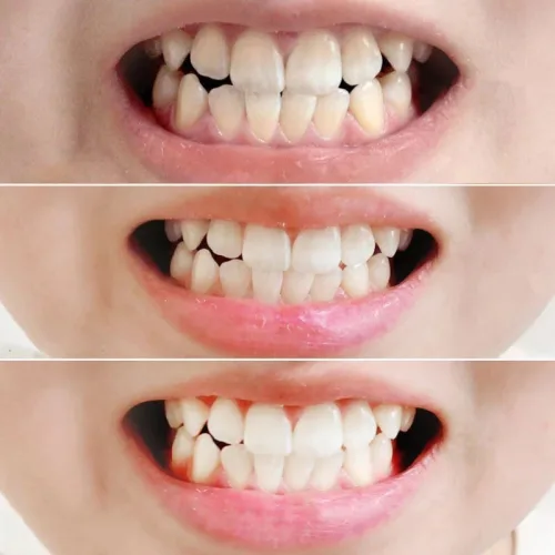 Kem Đánh Răng Median Màu Xanh Dương Dental IQ Tartar Toothpaste 93% Original 120g