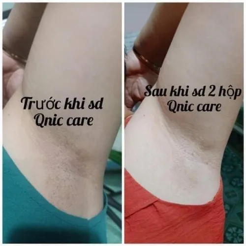 Kem Giảm Thâm Nách Q Nic Care Thái Lan 15g Phiên Bản Mới