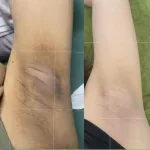 Kem Giảm Thâm Nách Q Nic Care Thái Lan 15g Phiên Bản Mới
