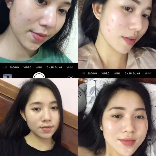 Không thử thuốc này sẽ không bao giờ biết khi nào da mặt mới được sạch mụn