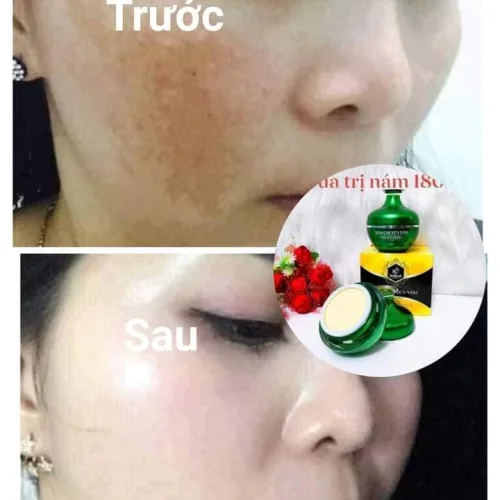 Nám nó rất lì nên người trị phải kiên trì