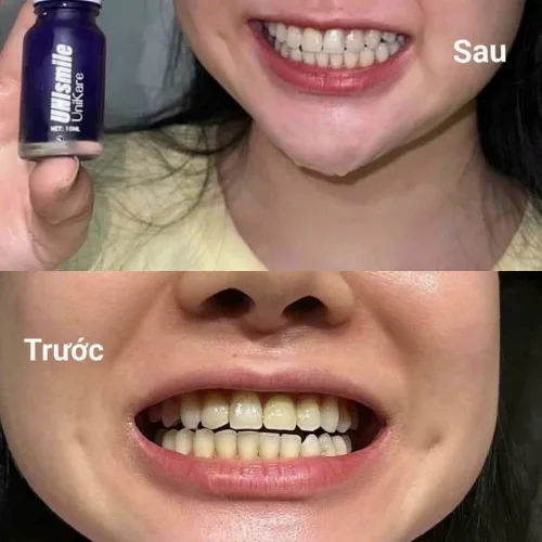 Serum Trắng Răng Unismile, Hỗ Trợ Cải Thiện Vết Ố Vàng Unikare
