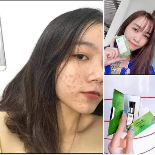 Trị mụn DR Mai vừa hợp túi tiền – vừa an toàn hiệu quả