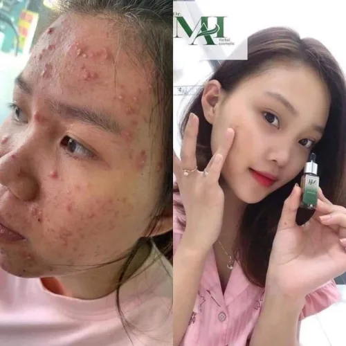 Trị mụn với DR Mai để cảm nhận hiệu quả nhanh chóng