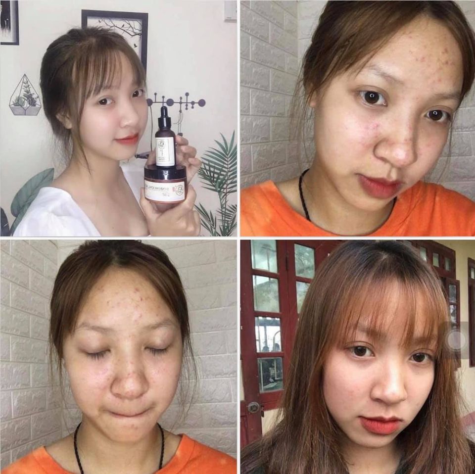 TRỊ MỤN BÀ LÃO - sản phẩm thảo dược thiên nhiên